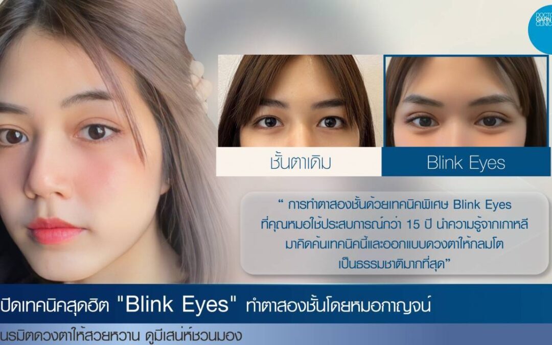 เปิดเทคนิคสุดฮิต “Blink Eyes” ทำตาสองชั้นโดยหมอกาญจน์ เนรมิตดวงตาให้สวยหวาน ดูมีเสน่ห์ชวนมอง